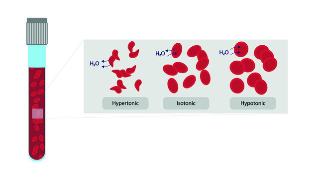 Human cell osmosis. Hemoglobin in a isotonic, hypertonic and Hypotonic illustration 