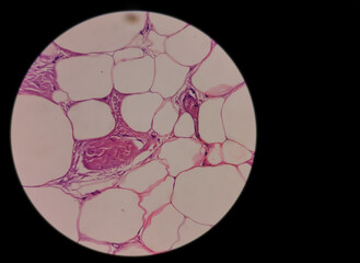 Lipoma, benign growth of fatty tissue, benign neoplasm, adipocytes, partially capsulated tumor, 40x microscopic view.