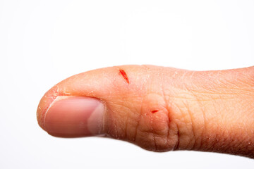 指の切り傷（冬のパックリ傷）