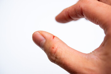 指の切り傷（冬のパックリ傷）