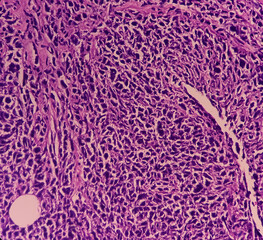 Microscopic image of Colorectal carcinoma and Amelanotic melanoma. Show malignant neoplasm, atypical squamous epithelial cells and areas of necrosis are noted.
