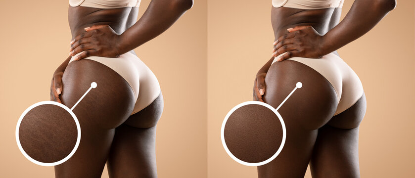 Before and after treatment for cellulite and stretch marks, collage