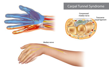 Carpal tunnel syndrome. Compressed median nerve. Anatomy of the carpal tunnel, showing the median nerve. - obrazy, fototapety, plakaty