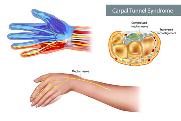 Carpal tunnel syndrome (CTS). Compressed median nerve. Anatomy of the carpal tunnel, showing the median nerve. 