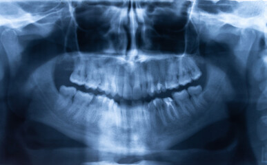 closeup of x-ray of a person's mouth and teeth