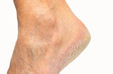 Fototapeta premium Cropped shot of a heel of a foot with arid skin