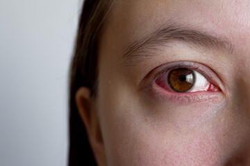 Close up irritated infected red bloodshot woman eye. Hemorrhage in the sclera or mucous membrane of...