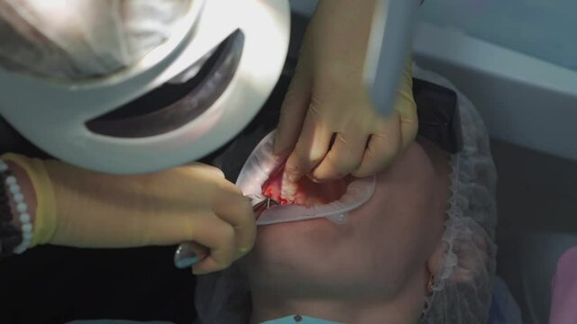 real. dentist pulls out a sick wisdom tooth. 