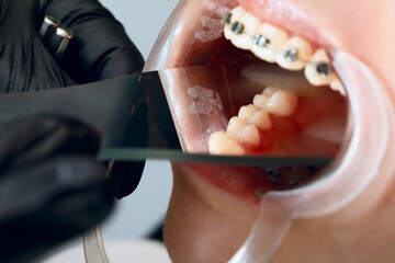 A young woman with metal braces is being examined by an orthodontist. Correction of the bite of teeth in the dental clinic. Concept of healthy teeth.