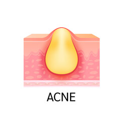 Formation of skin acne or pimple. Anatomy of skin. Medical beauty skin care concept. On a white background. 3D vector.