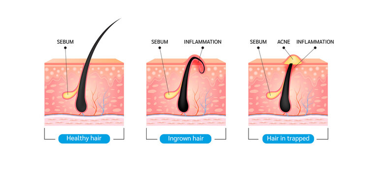 Ingrown hair. Hair has grown back into the skin surface after shaving. Formation of skin acne or pimple. Anatomy infographics of hair and skin. On a white background. 3D vector illustration.