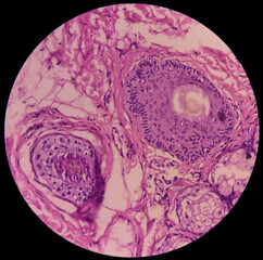 Tissue from face(biopsy): Microscopic image of intradermal nevus, show small nests of melanocytes...