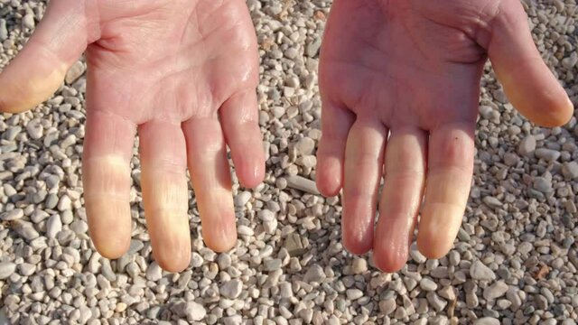 Hands of a person with Raynaud syndrome during an attack.
