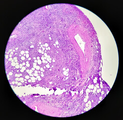 Urinary bladder cancer: microphotograph transitional cell carcinoma, high grade, malignant neoplasm, Urinary bladder tumor, 40x view