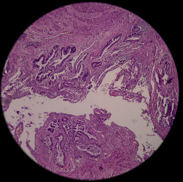 Cholelithiasis of Gallbladder, microphotograph of chronic cholecystitis, show perimuscular fibrosis and infiltration of chronic inflammatory cells, rokitansky-aschoff sinuses are noted.