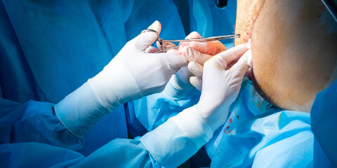 Hands of surgeons in sterile gloves with surgical instruments during surgery. Surgical...