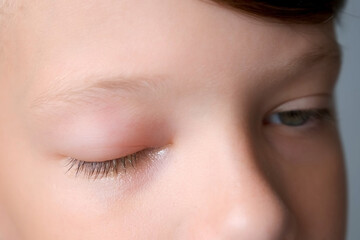 Face of boy with a swollen eye from an insect bite, closeup view. Allergy to insect bites. Closed red sick eye of a teen boy. Eye disease in a child, conjunctivitis, inflammation in the eye.