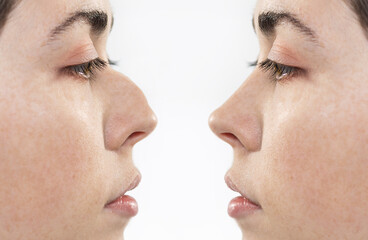 Two female faces close-up showing the result before and after rhinoplasty. Side view. White...