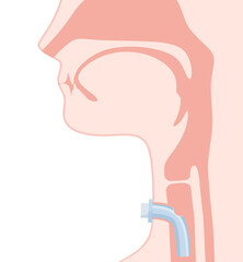 気管カニューレのイラスト_スピーチカニューレ_矢状断