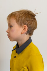 Injury of boy's head by falling collision. Hematoma under the eye. The child is standing sideways.