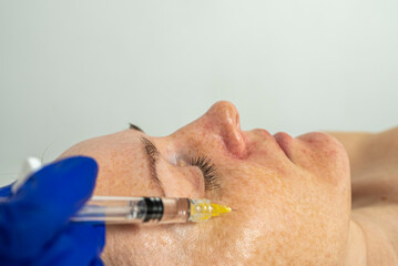 botulinum toxin injection on eye area, for lifting skin around eyes, mesotherapy