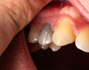 Black tooth in the mouth of a man after nerve depulpation. Dead darkened tooth, macro