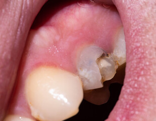 Obraz premium Chipped piece of a dead pulp tooth. Restoration of a damaged tooth in dentistry, defect in tooth enamel, thin tooth walls. Macro
