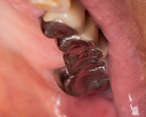 Metal crowns on the teeth in the mouth of a woman. Old harmful crowns causing allergies and diseases, macro