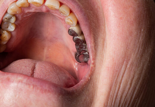 Old metal crowns in the patient's mouth on the chewing teeth. Dental prosthetics, macro