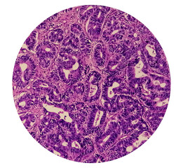 Adenocarcinoma. Photomicrograph. Histology. Microscopic slide view. 10x