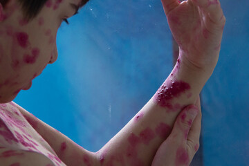 Close-up of a child's skin rash. Varicella zoster virus virus.