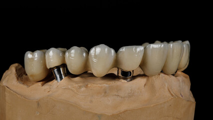 metal ceramic prosthesis for the entire upper jaw on the model © Dental Pro Content