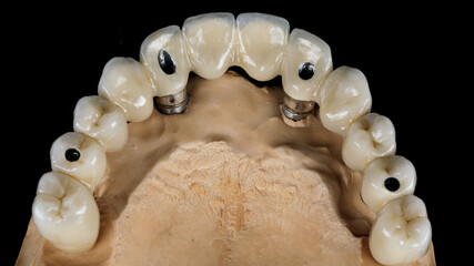 metal-ceramic prosthesis on the upper jaw on the model, top view on a black background