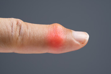 Index finger with rheumatoid arthritis. joint inflammation