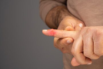 Index finger with rheumatoid arthritis. joint inflammation