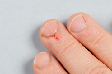 Small wound on the finger, fresh blood after injury, close up, bleeding