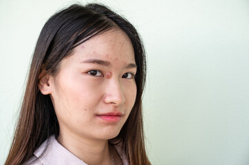 Ugly Asian woman with large pimple (or Elephant head acne) and acne inflamed on her face. Hard...