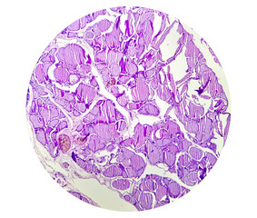 Thyroid cancer: Microscopic image of papillary thyroid carcinoma, showing malignant neoplasm...