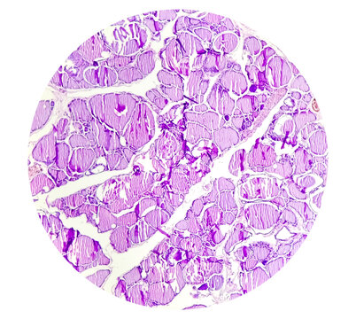 Thyroid cancer: Microscopic image of papillary thyroid carcinoma, showing malignant neoplasm composed of atypical epithelial cells, few nuclear grooving cells seen.