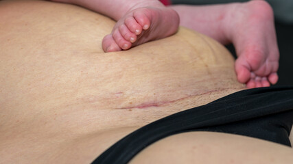 Closeup of a woman belly with a scar from a cesarean section with baby feet of the newborn on the belly - obrazy, fototapety, plakaty