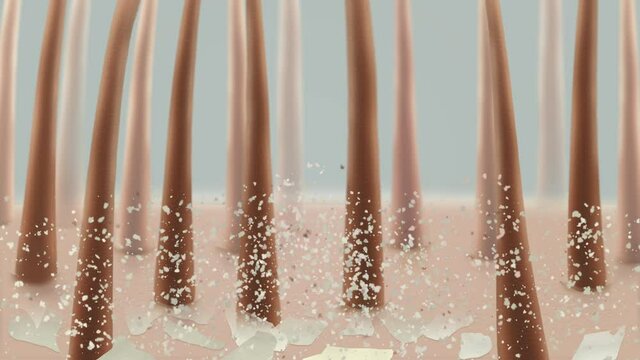 Scalp treatment. Dandruff on hair. Close-up. The medicine gets on the scalp and the hair recovers, dandruff disappear. Animation.