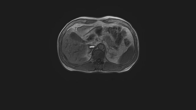 Voluminous CT scan of the abdomen. Computed tomography of the gastrointestinal tract, liver and kidneys