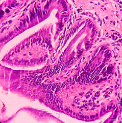 Fototapeta na wymiar Chronic cholelithiasis of Gallbladder, microphotograph of chronic cholecystitis, show perimuscular fibrosis and infiltration of chronic inflammatory cells