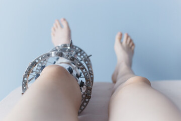 leg in Ilizarov's external fixator, Ilizarov's apparatus