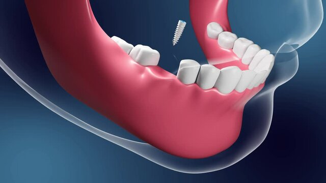 3d medical animation of ceramic tooth implant dental installation on dark background