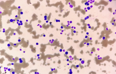 Photomicrograph of blood film, plasma cell leukemia, plenty atypical cells, rouleaux formation present. microscopic 100x view