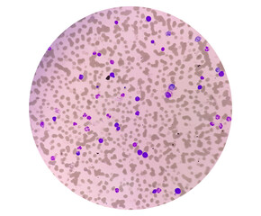 Microscopic image of Plasma cell leukemia (PCL) or Waldenstrom macroglobulinemia.