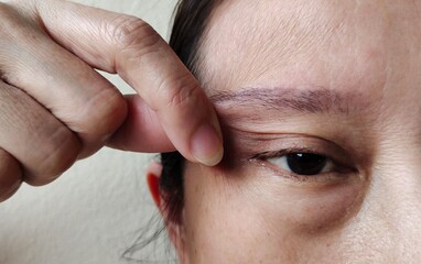 close up portrait the hand squeezing the flabbiness adipose skin corner of the eyelid, problem skin...
