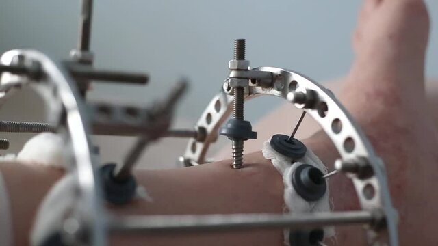 leg in Ilizarov's external fixator, Ilizarov's apparatus