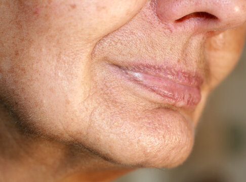 Flabbiness of the skin of the cheeks. Wrinkles on the face. Nasolabial wrinkles.